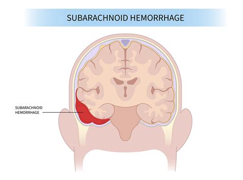 Subarachnoid Hemorrhage | Aurora Health Care