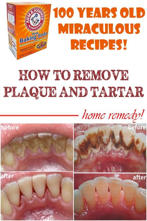 Home remedies to remove plaque and tartar - Beauty Tips Diary | Teeth ...