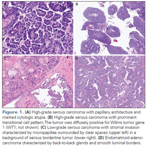 Morphologic, Immunophenotypic, and Molecular Features of Epithelial ...