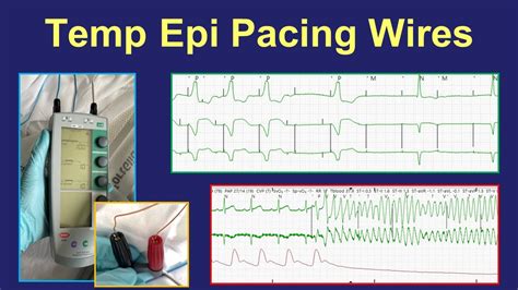 Surgical epicardial pacing wires - uses and management - YouTube