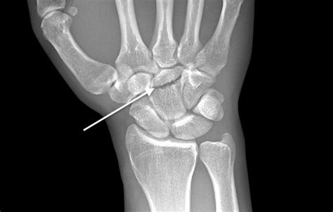 CAPITATE FRACTURE | Hand Surgery Source