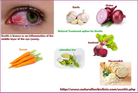 Uveitis Treatment Naturally