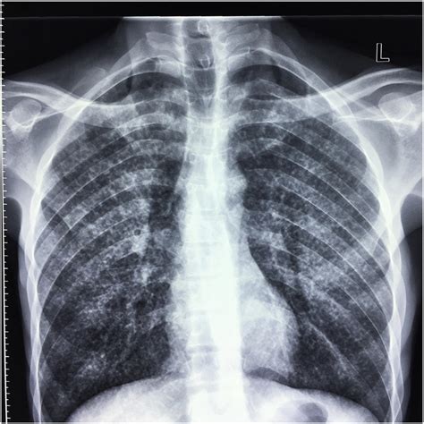 Chest X-ray in a patient with disseminated TB showing the... | Download ...