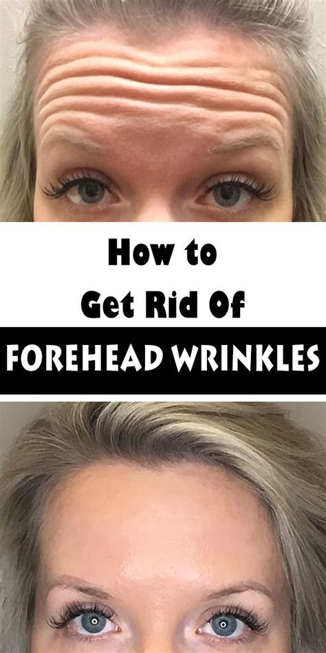 How To Get Rid Of Forehead Wrinkles Without Botox | Healthcare Topic