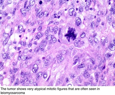 Pathology Outlines - Leiomyosarcoma