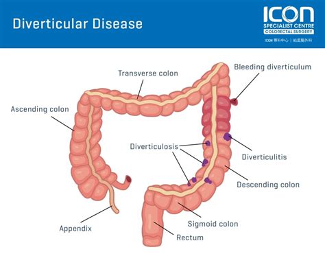 Diverticular disease — Icon Specialist Centre