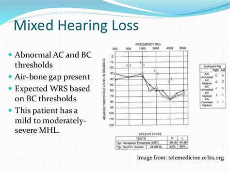 Audiogram interpretation