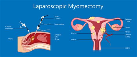 Myomectomy Surgery Melbourne » Fibroids Removal — A/Prof Alex Ades