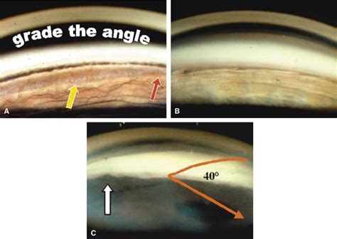 Gonioscopy Corneal Wedge