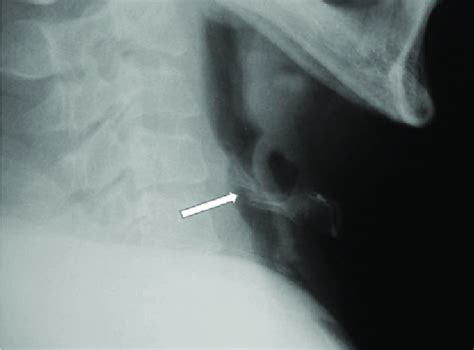 Lateral X-ray revealing fracture of the hyoid bone on the right greater ...