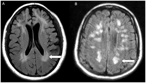 Forgotten Diseases Research Foundation | Hashimoto's encephalopathy (HE)