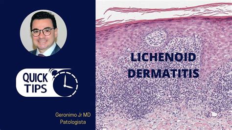 LICHENOID DERMATITIS PART I - YouTube