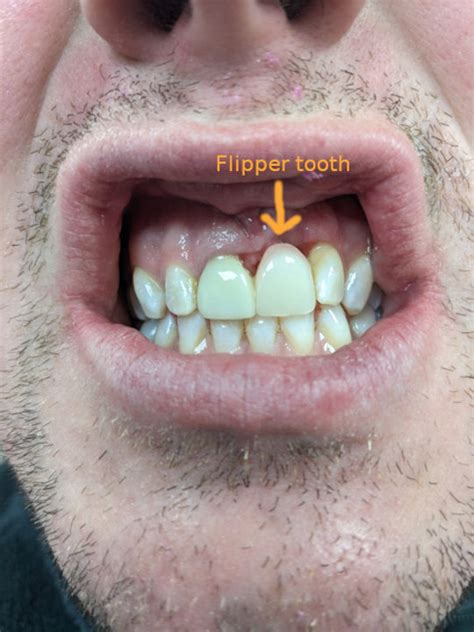 Flipper Tooth: Things To Know - 1311 Jackson Ave Dental | Dentist in ...