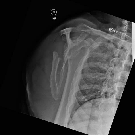 Scapular fracture | Scapular, Healthcare careers, Fracture