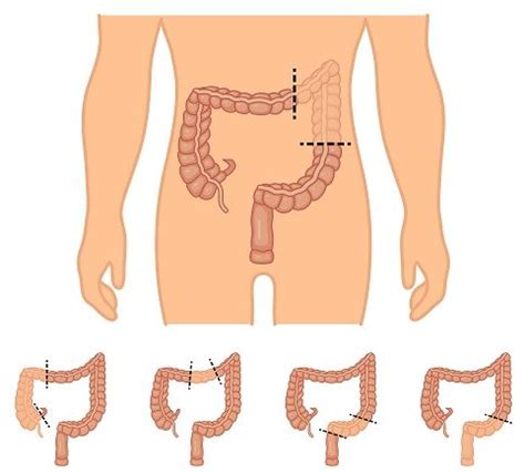 Laparoscopic Colon Resection - Johns Creek, Alpharetta, Roswell ...