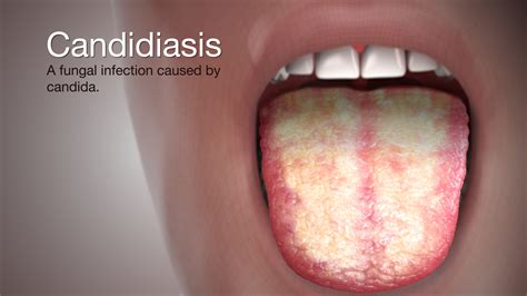 Candidiasis – Symptoms, Causes & Treatment