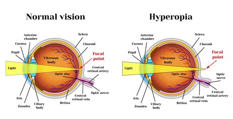 BatesEyeExercises.com === Hyperopia exercises