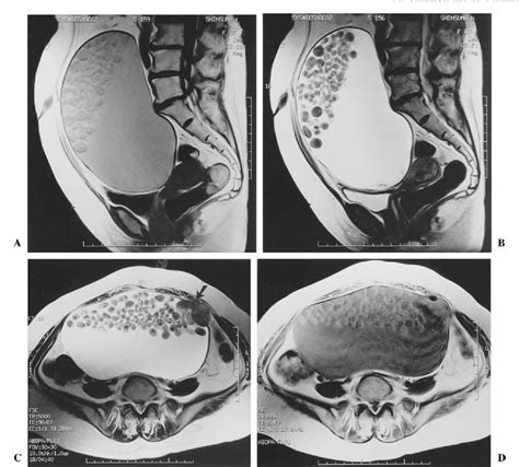 Figure 1 from MRI findings of an ovarian dermoid cyst with malignant ...