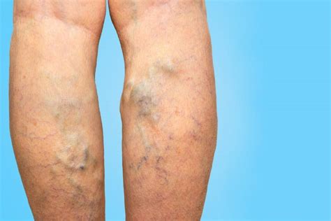 Venous Ulcers: Who Is At Risk?: Vascular Institute of New York: Board ...