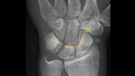 Carpal Bones Xray