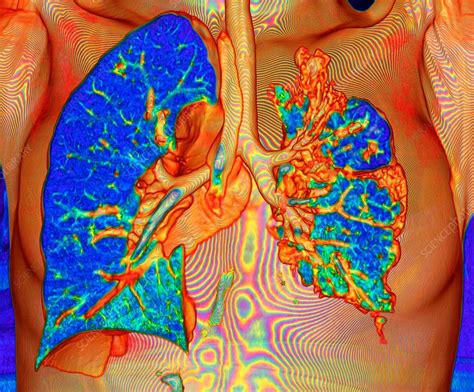 Collapsed lung, 3D CT scan - Stock Image - C036/0523 - Science Photo ...