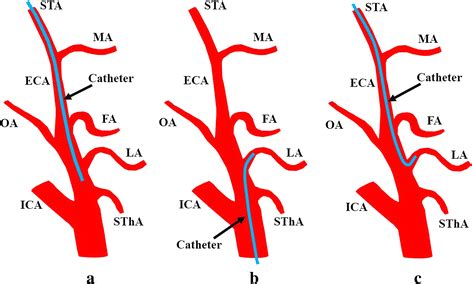 Catheterization method for intra-arterial chemotherapy. Three types of ...