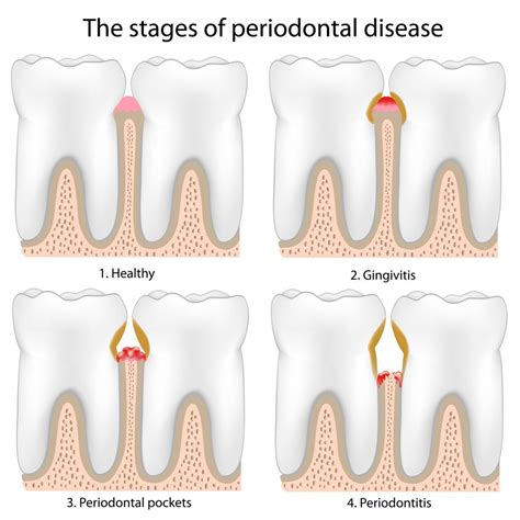 Signs & Symptoms of Periodontal Disease