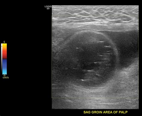 Testicular Hernia Ultrasound