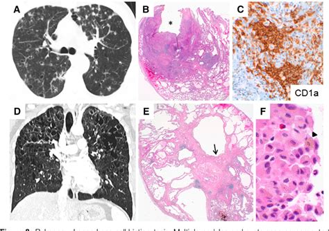 Figure 2 from Diffuse Cystic Lung Disease. Part I. | Semantic Scholar