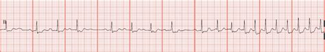 EKG Rhythm Strips 56: Atrial Fibrillation