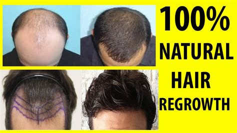 How Can I Regrow Hair | ubicaciondepersonas.cdmx.gob.mx