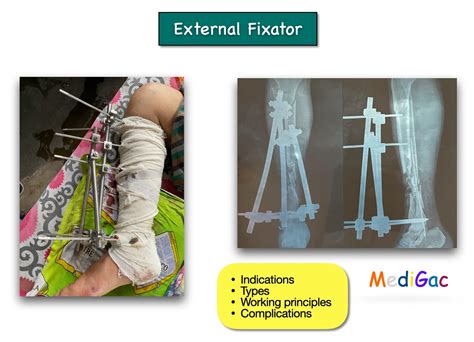 External fixation – Indications, Types, Working principle ...