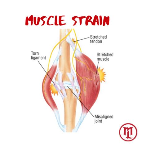 Best Recovery Tips For Healing Muscle Strains – Lee's Fitness Unlimited