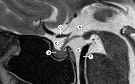 Diaphragma Sellae Mri