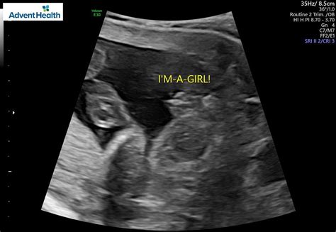 Skeptical it's a girl (20 week ultrasound) | BabyCenter