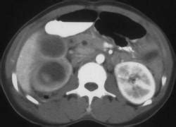 Pyonephrosis Right Kidney - Kidney Case Studies - CTisus CT Scanning