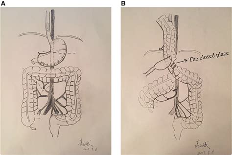 Frontiers | Distal-continual colon interposition for esophageal ...