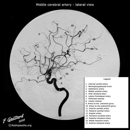 Ophthalmic artery | Radiology Reference Article | Radiopaedia.org