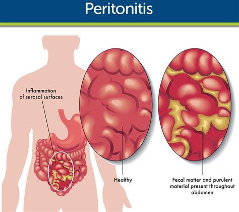 Peritonitis, bacterial peritonitis causes, signs, symptoms and treatment