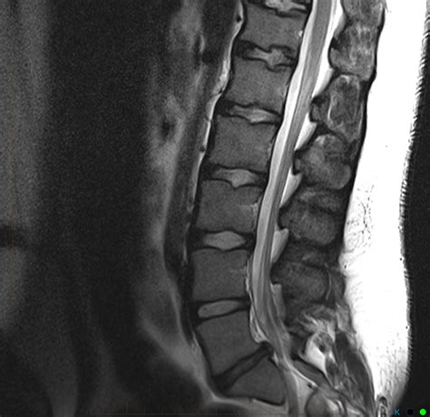 MRI assessment of child with right sided sciatica - MRI at Melbourne ...