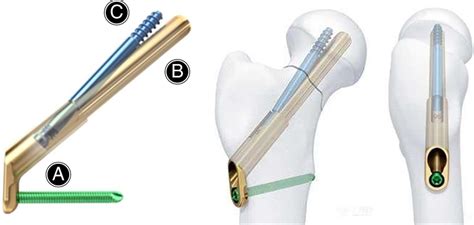 FNS consists of three parts: (A) the plate and locking screw in the ...