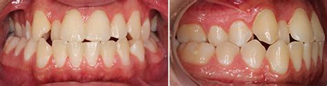 Anterior Crossbite | Posterior Crossbite | Effects and Treatment