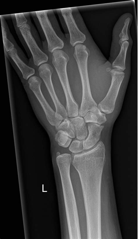 Figure Wrist X Ray With Labeled Osseous Anatomy Contributed By John ...