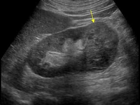 Kidney Tumor Ultrasound