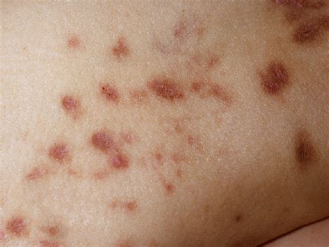 How Does Diabetic Skin Rash Look Like?