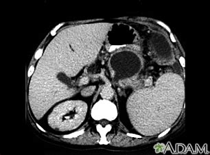 Normal Ct Scan Abdomen