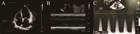 TTE and TEE findings before operation. (A-B) The preoperative TTE ...