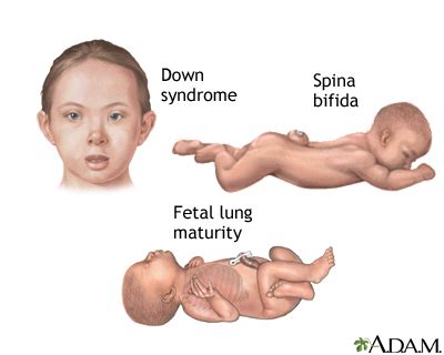 Birth Defects In Babies