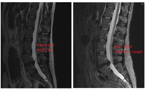 Recurrent Herniated Nucleus Pulposus - Shim Spine