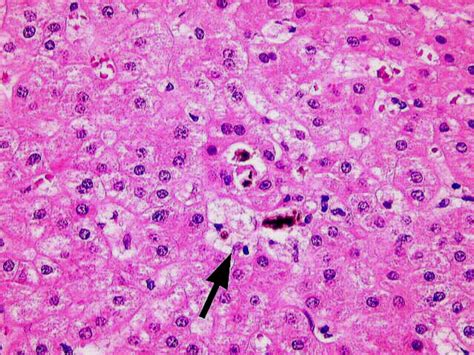 TPIS Chronic Liver Rejection Foamy Macrophages Image